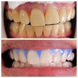 Teeth Whitening Classes