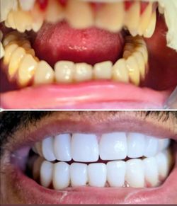 Veneers