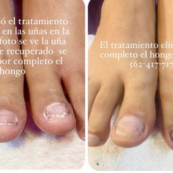 Hongos Tratamiento 