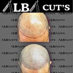 Are You Loosing You Hair? Get Scalp Micro Pigmentation Hair Loss Solution,  Se Le Estay Calle Do El Pelo? Tenemos La Solución, Ya No Se Ponga Cachucha
