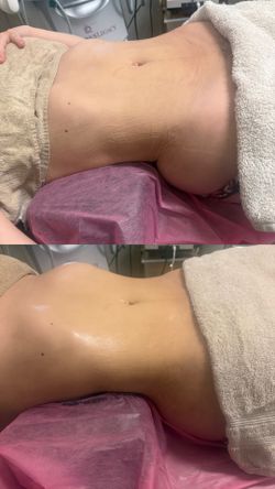 Post Operatorio Masajes Reductores