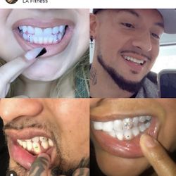 Tooth Gems 