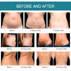 Cavitation Treatment