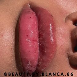 Hyaluron Lip Fills