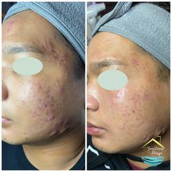 Acne?