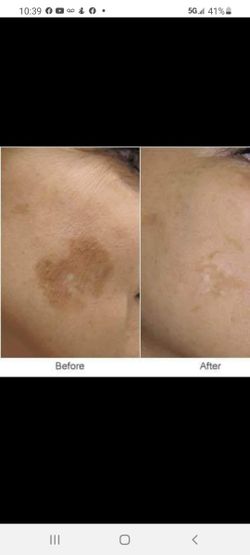 Whitening Soap For Dark Spots