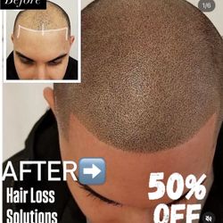 Hairloss Solutions - Scalp Micropigmentation 