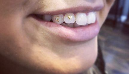 Tooth gems tooth dermal