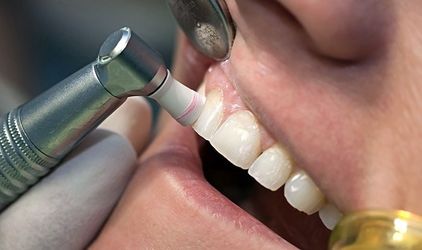 Teeth Cleaning