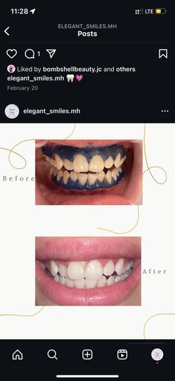Teeth Whitening 