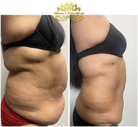 Stomach Fat Reduction