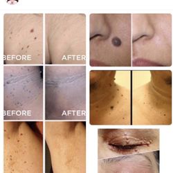 SKIN TAG/MOLE REMOVAL