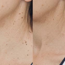 Skin Tag Removal KIT