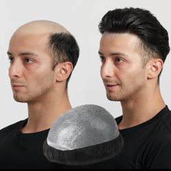 Hair Loss Solution for Men 