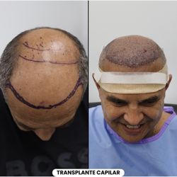 Hair Implant