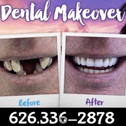 Dental Implant