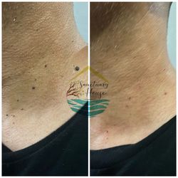 Skin tag removal