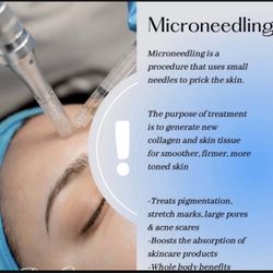 Microneedling 