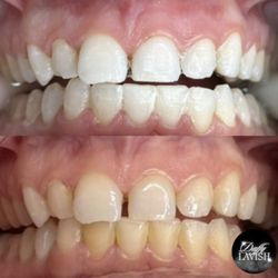 Teeth Whitening