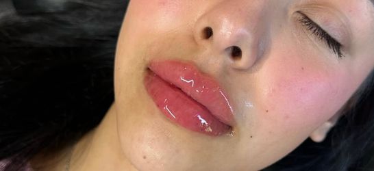 Lip filler/injections