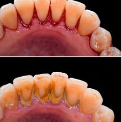 Buscando Pacientes Para Limpieza Dental *GRATIS*