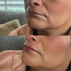 Half Syringe Lip Filler 