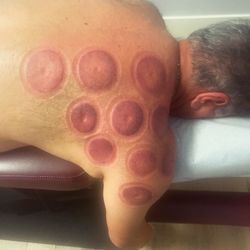 Cupping Therapy With Red Light Therapy