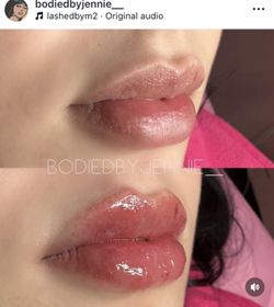 Lip Filler