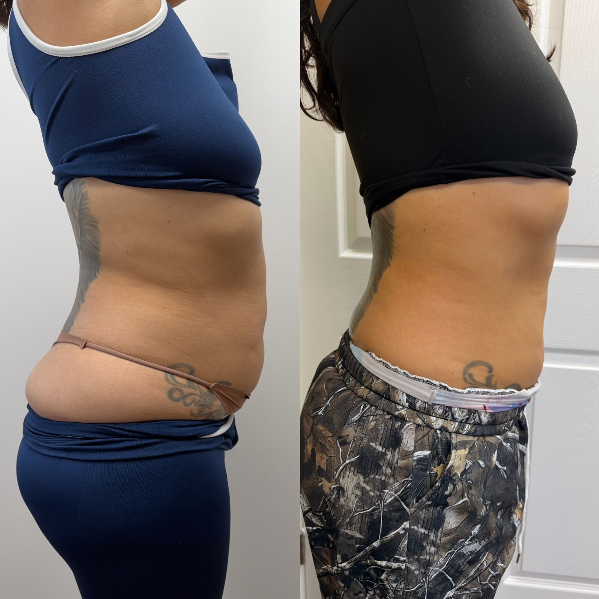 Body sculpting Machine