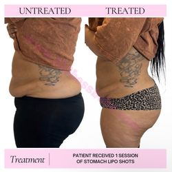 FREE LASER LIPO