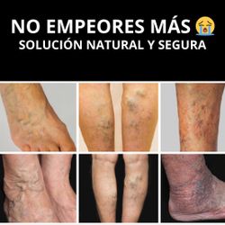 Varices O Arañitas? Solución Natural Y Segura 🌿✅ Sin Agujas