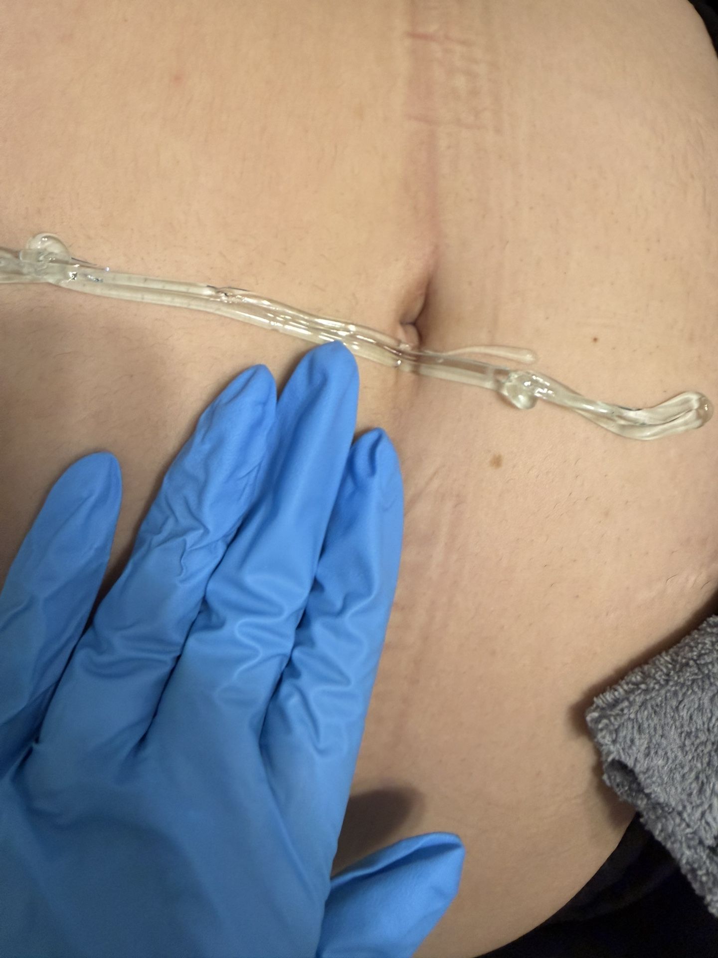 Laser Hair Removal