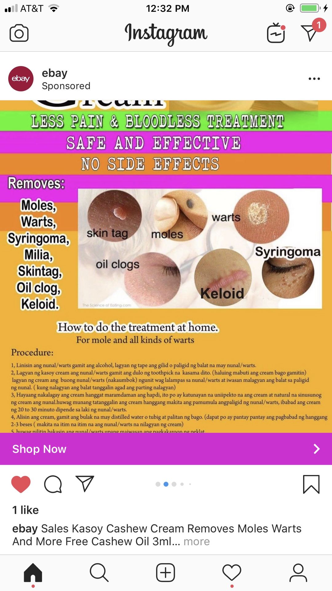 Kasoy Cream Removes moles, keloid, skin tag, warts and more