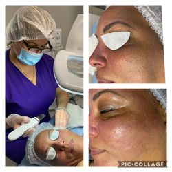 Limpieza Facial Profunda. Peeling Ultrasónico.
