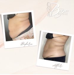 Body Sculpting
