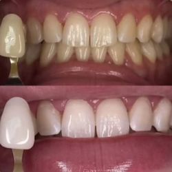 Whitening
