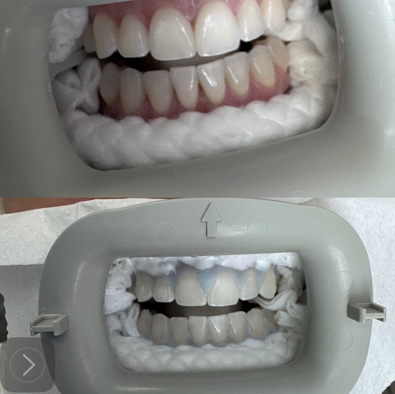 Teeth Whitening