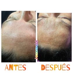 Fibroblast es la Mejor opción .