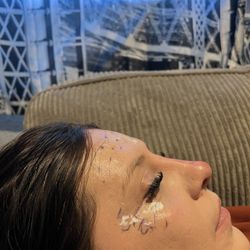 Nose Filler And Full Face Botox 