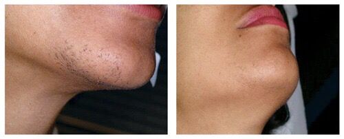 ELECTROLYSIS(permanent hair removal)