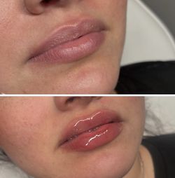 LIP FILLER 