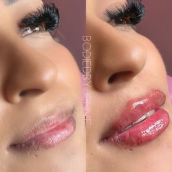 Lip Filler