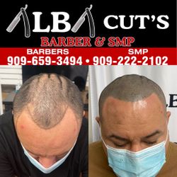 Get Your Hairline Back Stop Wearing A Hat 🧢  Get SMP. Pare De Esconder Su Calvicie 🧑‍🦲 Con Una Cachucha 🧢  