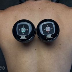 Cupping therapy