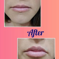 Lip Plumper 