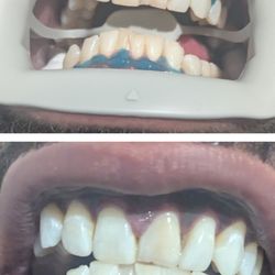 Teeth Whitening 