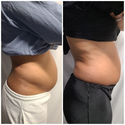 Body Sculpting