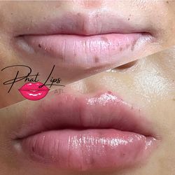 LipFiller NEW ClLIENT SPECIAL