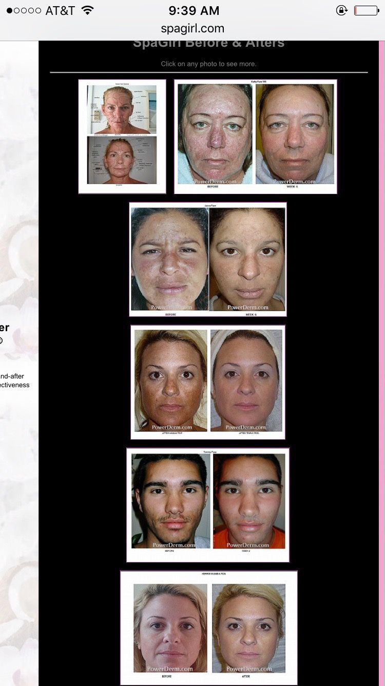 Kinetic Dermabrasion Facial equipment