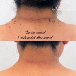 Skin Tag Removal, Plasma Fibroblast Skin Tightening 